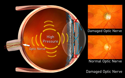 Glaucoma Center - Fredericksburg