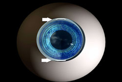 Pre-existing astigmatism can be treated with limbal relaxing incisions