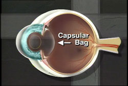The capsular bag may become cloudy in the future.